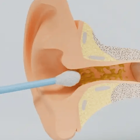 Why Cotton Swabs Are a Bad Idea