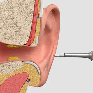 WaxClean® - Smart Ear Cleaning With Advanced Technology